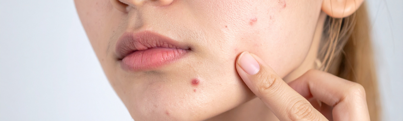 Hormonale acne: uitbraken door hormonen begrijpen en behandelen